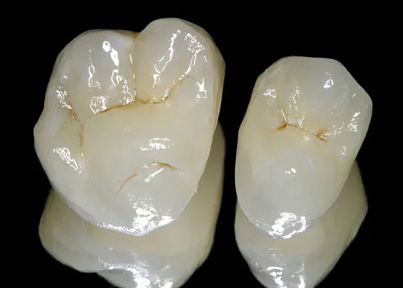 Corona E-max: Empress – Prótesis dental de alta gama, 100 % cerámica, para una restauración estética y duradera 2